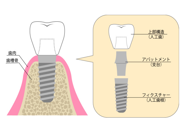 インプラント治療とはどのような治療なのか