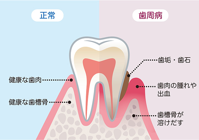 歯周病の原因