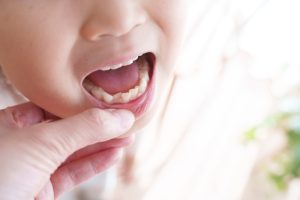 歯並びや咬み合わせの改善